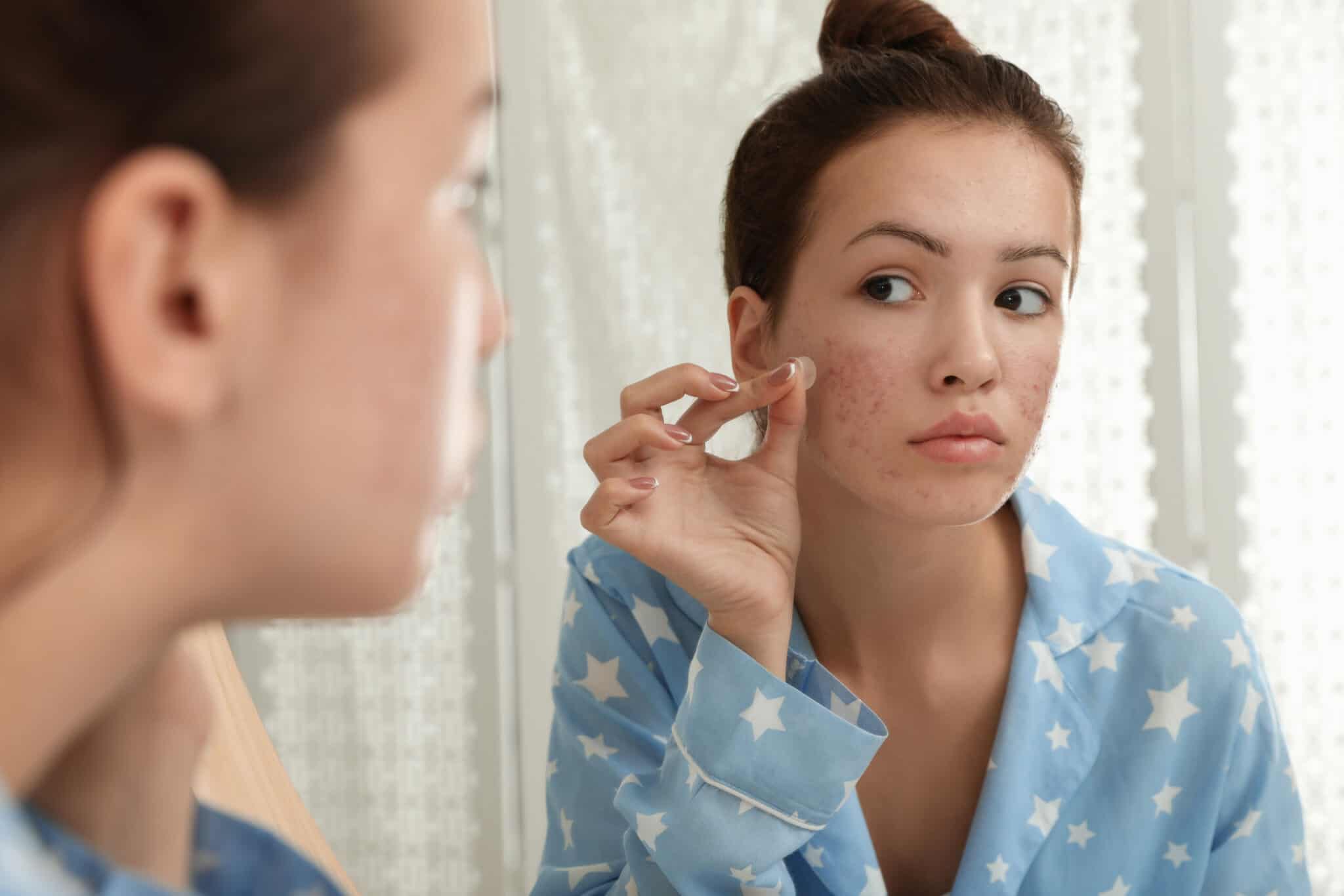 Teen,Girl,Applying,Acne,Healing,Patch,Near,Mirror,In,Bathroom
