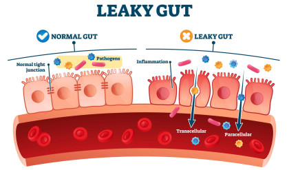 Leaky,Gut,Syndrome,As,Medical,Chronic,Inflammation,Condition,Explanation.,Labeled